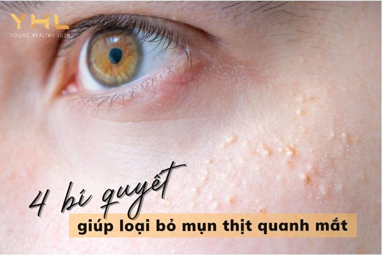 4 bí quyết làm giảm mụn thịt quanh mắt hiệu quả tại nhà