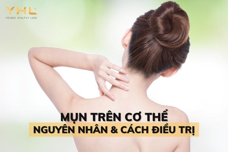 Mụn trên cơ thể: Nguyên nhân hình thành & cách điều trị