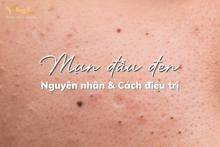 Mụn đầu đen: Nguyên nhân hình thành và cách điều trị hiệu quả tại nhà