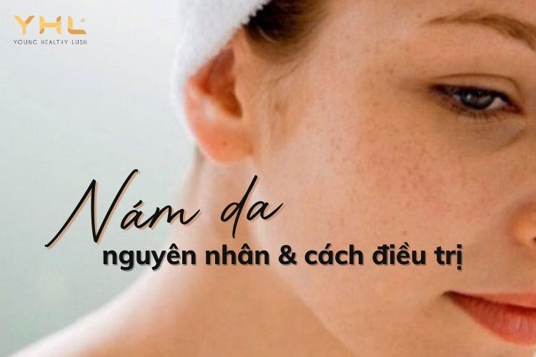 Nám da: Nguyên nhân & mẹo điều trị cực đơn giản tại nhà